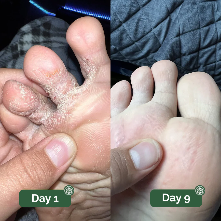 Athlete’s foot before and after