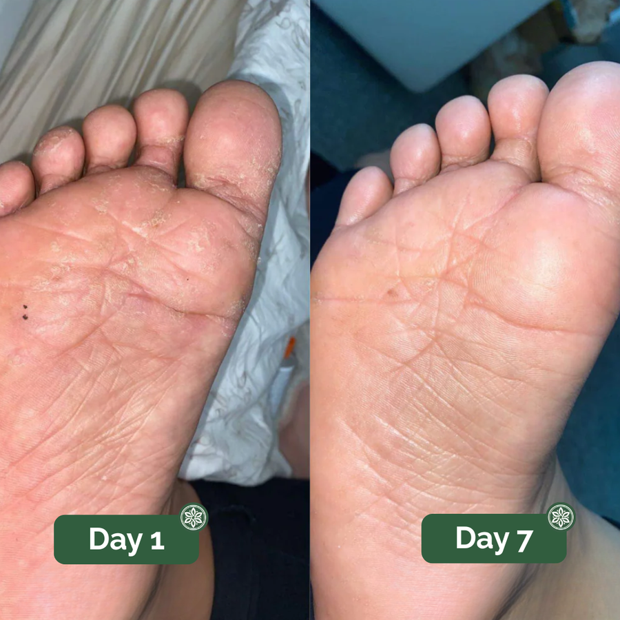Athlete’s foot before and after