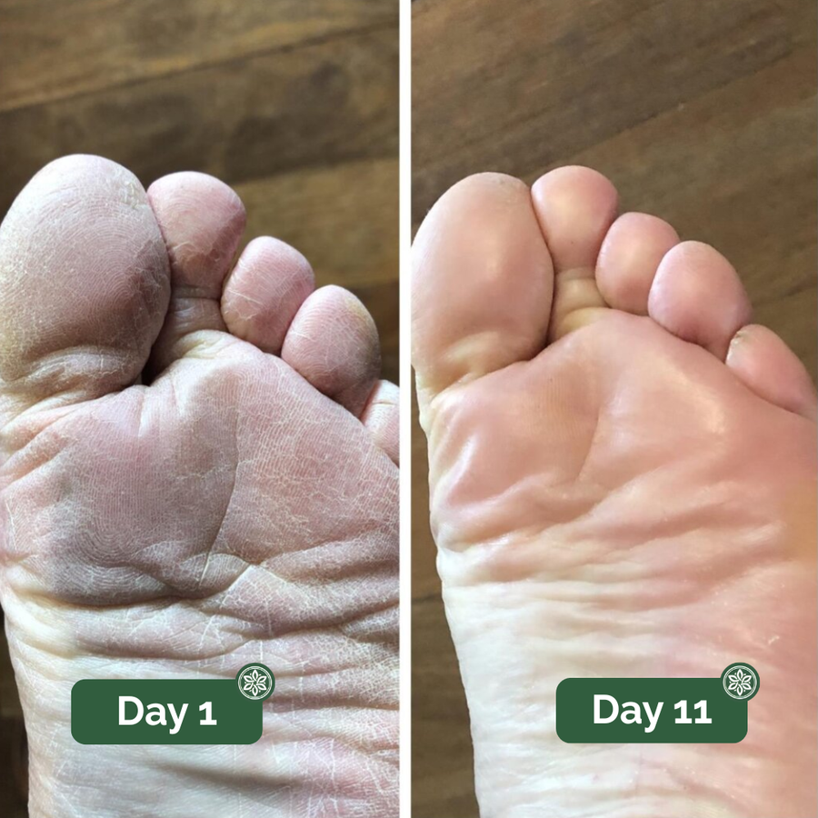 Athlete’s foot before and after