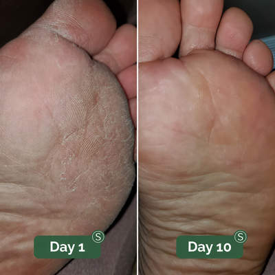 Skye Antifungal Soap — image 3
