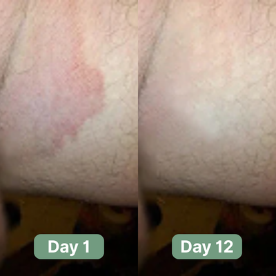 Skye Antifungal Soap